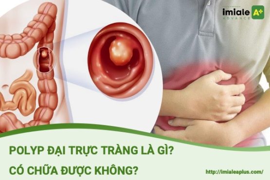 Polyp đại trực tràng là gì? Có chữa được không?