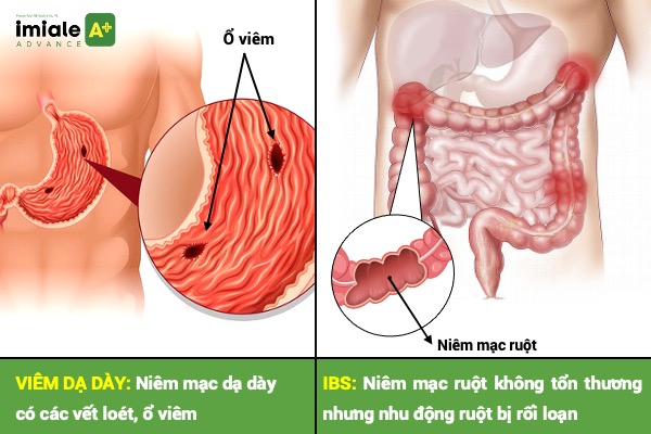Thế nào là viêm dạ dày và hội chứng ruột kích thích